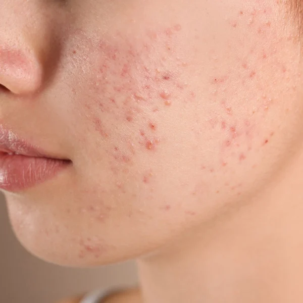 Signature Peel - Clarity™