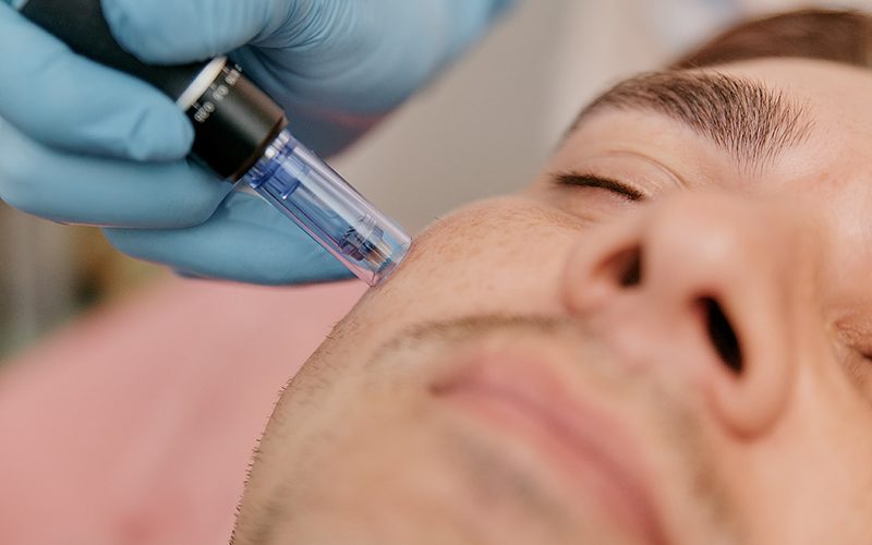 Collagen Induction Therapy Microneedling For the face of a European man close-up Collagen Induction Therapy Microneedling For the face of a European man close-up